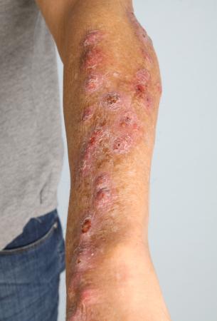 Arm van persoon met Mycobacterium marinum infectie
