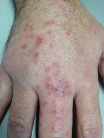 Hand van persoon met Mycobacterium marinum infectie